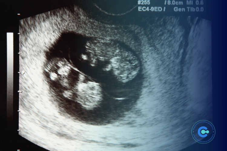 Síndrome de Transfusão Feto-Fetal